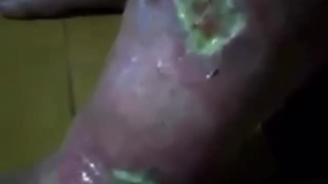 Very graphic vaxx injury demonstrating true depravity