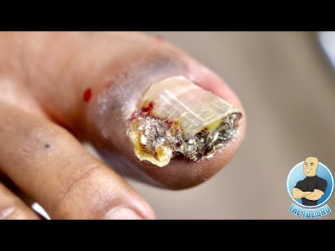 #YouNastyMFSeries  OVERGROWN INFECTED INGROWN TOENAIL REMOVAL ***WITH A SUPER SURPRISE***